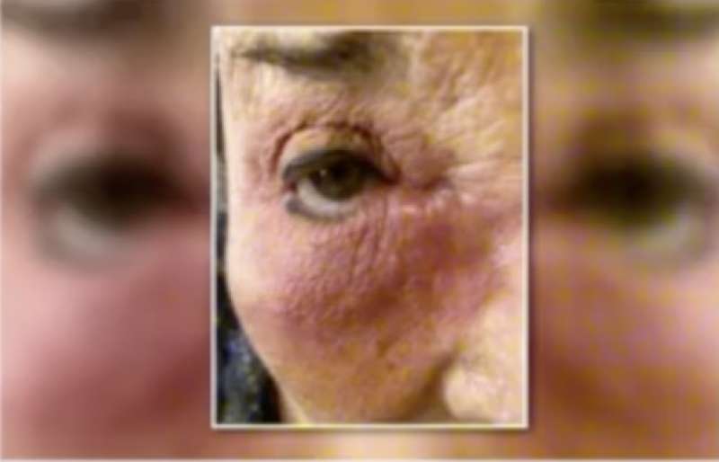 Patrizia De Black sfigurata in volto: ecco cosa le è successo [FOTO]